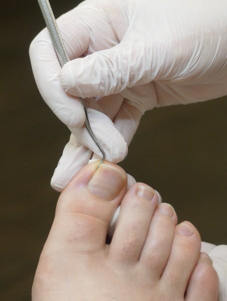 pédicure ongles incarnés