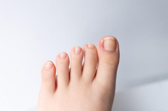 traiter ongle incarné
