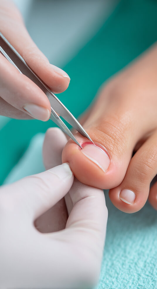 Traitement ongle incarné